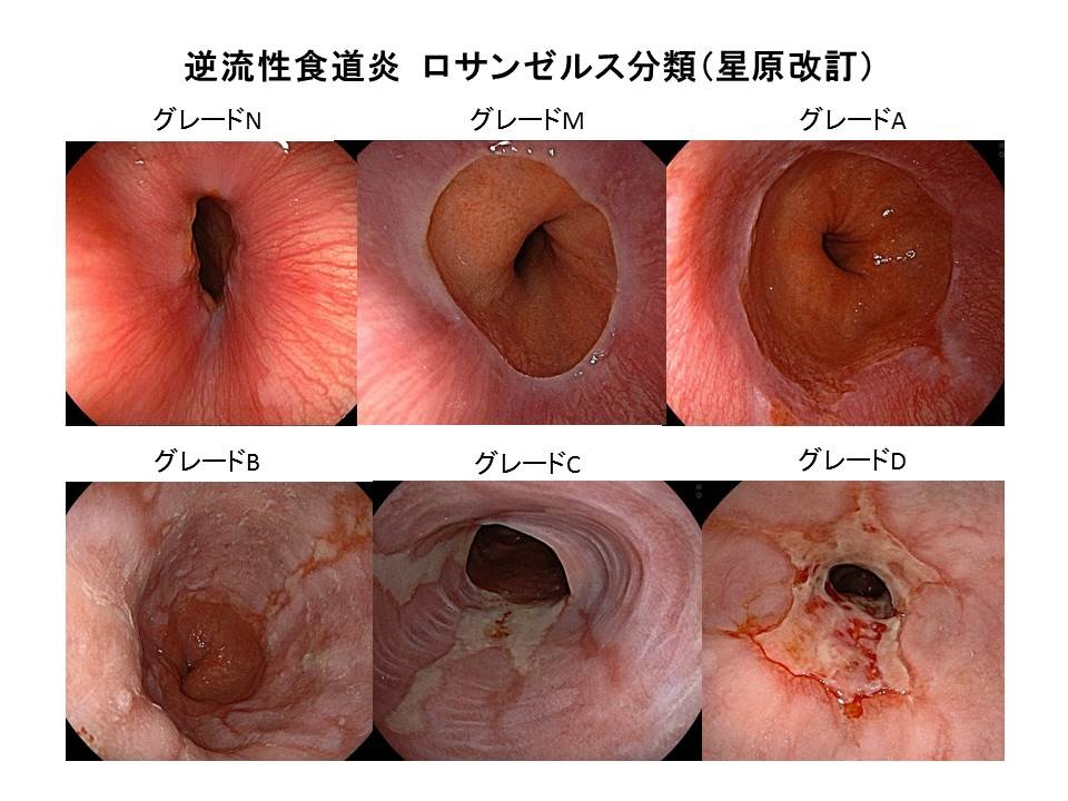 逆流性食道炎 ロサンゼルス分類(星原改訂)